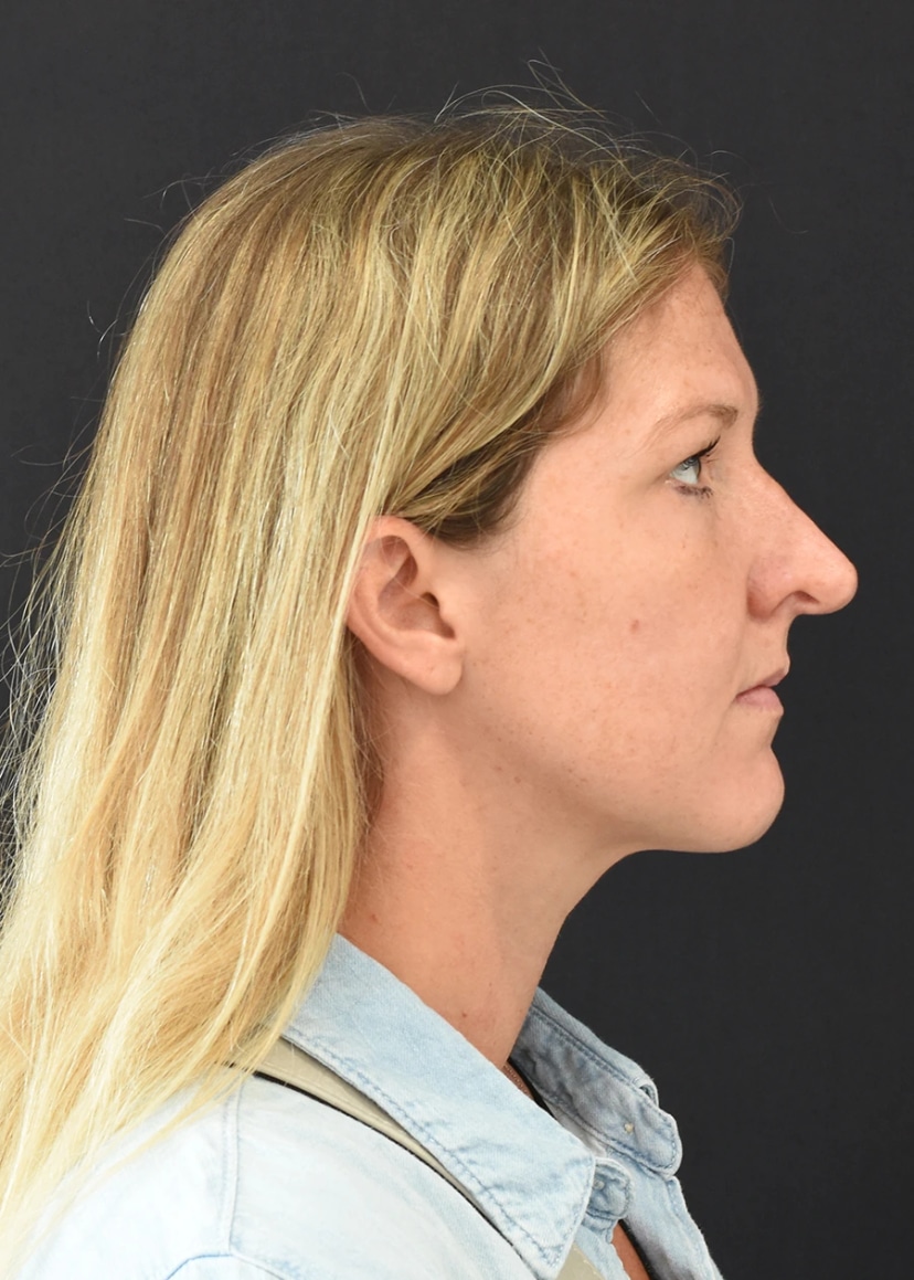 Rhinoplasty Patient 3 Set 2 Before