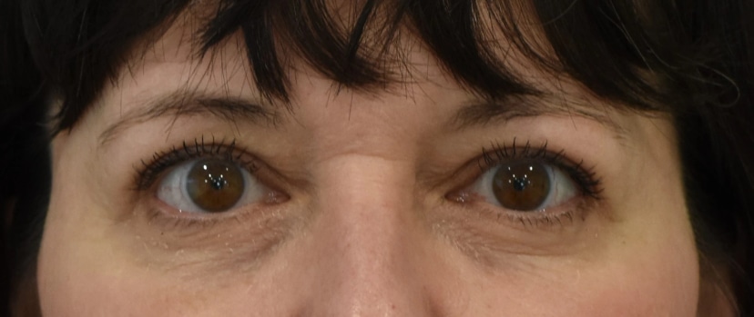 Eyelid Surgery Patient 6 Set 1 After