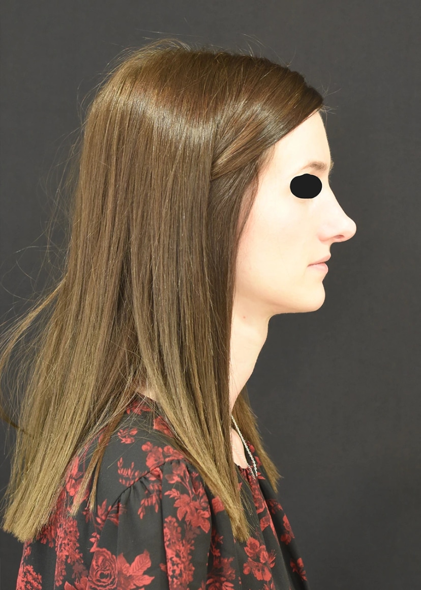 Rhinoplasty Patient 2 Set 2 After